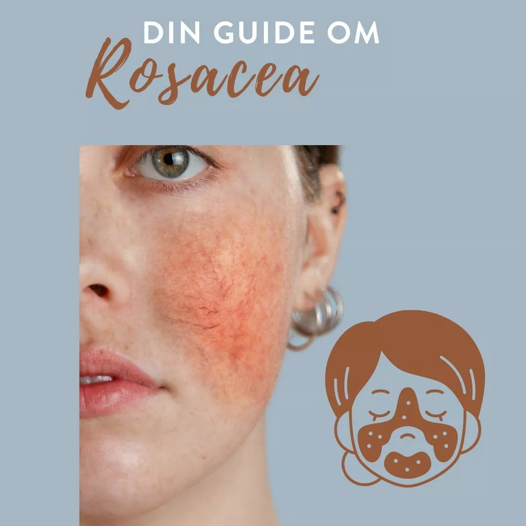 Rosacea – orsak, symtom och behandling