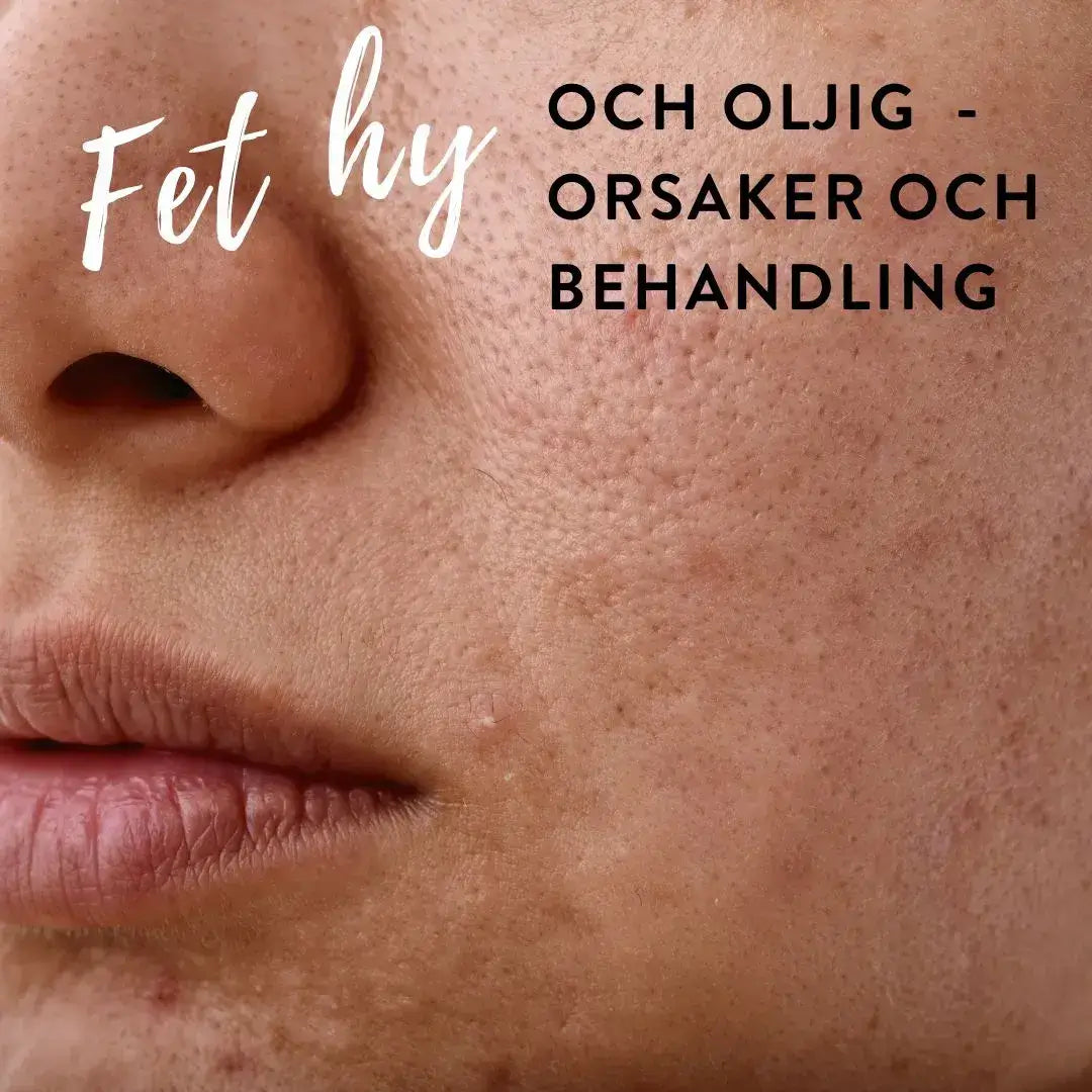 Fet hy: vård och tips